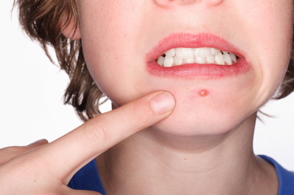Comment séduire les filles qu'on a de l'acné